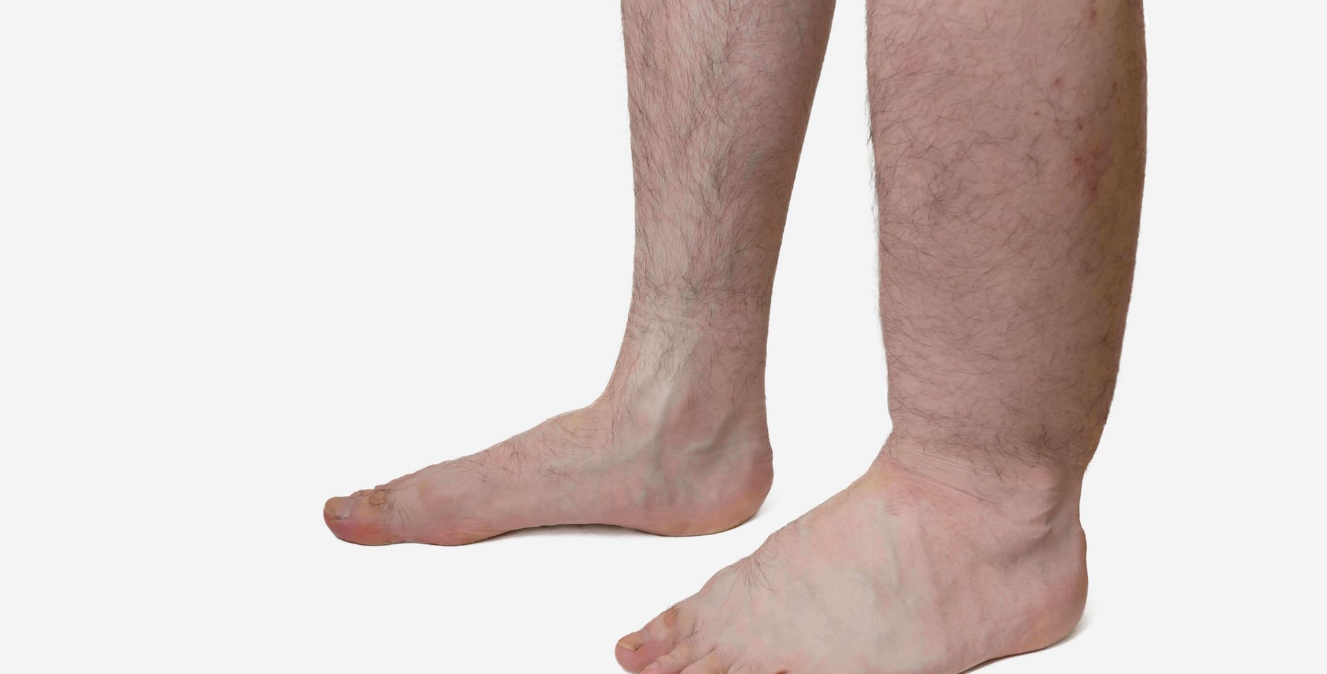 Drei Frauen stehen nebeneinander. Die zwei Frauen außen leiden an Elephantiasis, eine extreme Schwellung durch Lymphstau. Bei der Elefantenkrankheit weisen die stark geschwollenen Beine große Hautfalten auf und sind nicht mehr frei beweglich. Die Einschränkung der Lebensqualität ist enorm: Wer an Elephantiasis leidet, kann kaum einem normalen Alltag mehr nachgehen. Jeder Schritt wird zur Qual – sofern er überhaupt noch möglich ist.