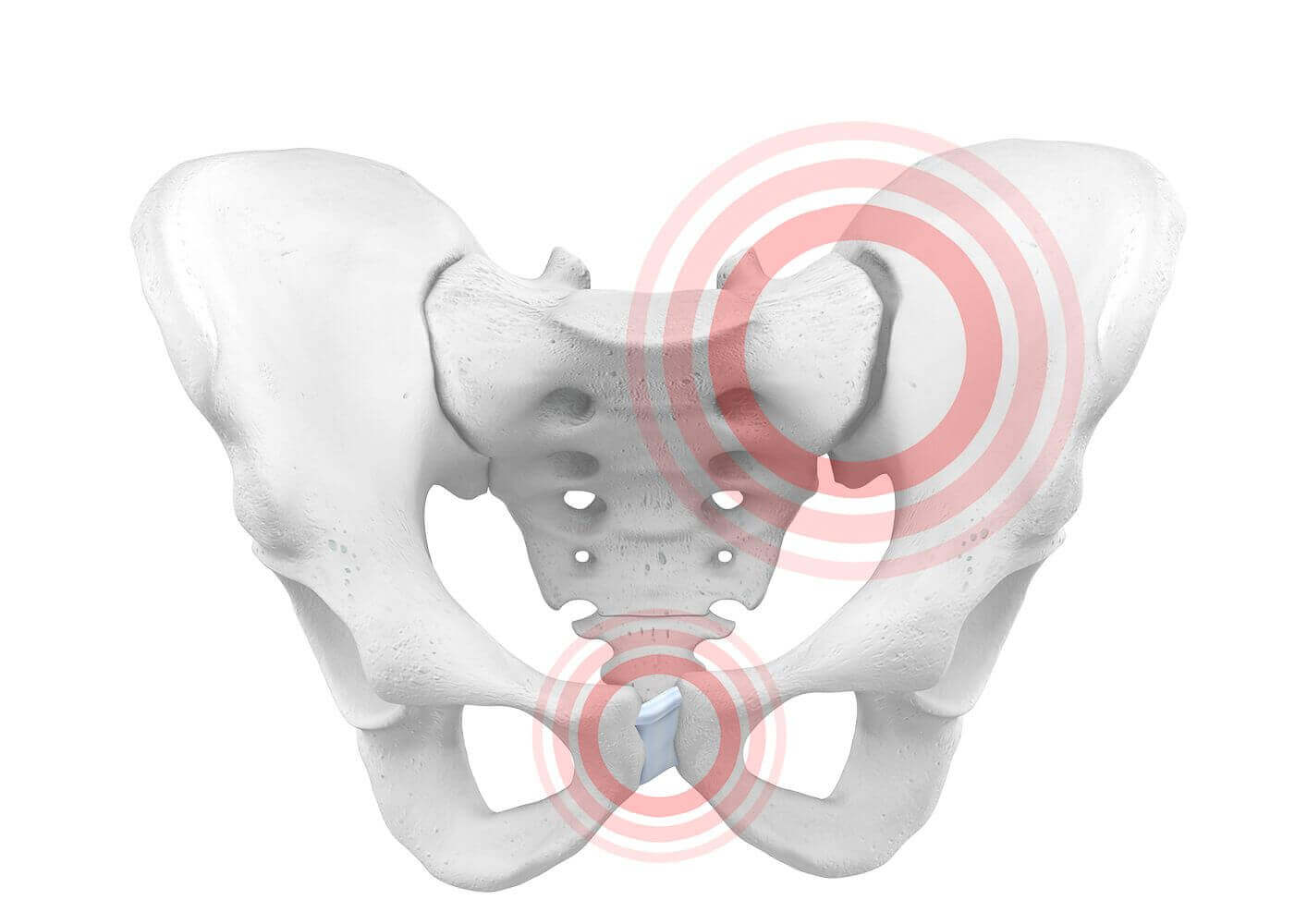 Darstellung der Anatomie des Beckens bei einer Beckenringinstabilität. Besonders häufig sind Schwangere durch die enorme Veränderung und Belastung des Körpers von einer Beckenringinstabilität betroffen.